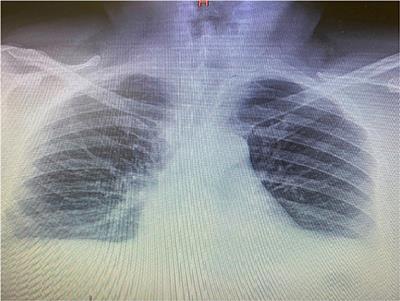 Late Reactivation of SARS-CoV-2: A Case Report